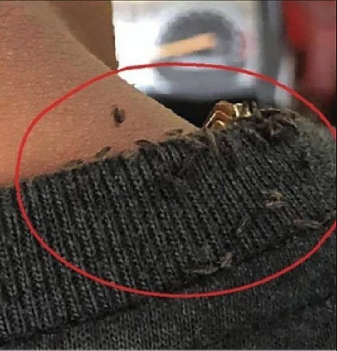 Muž sa stal virálnym na internete kvôli extrémnemu zamoreniu všami.