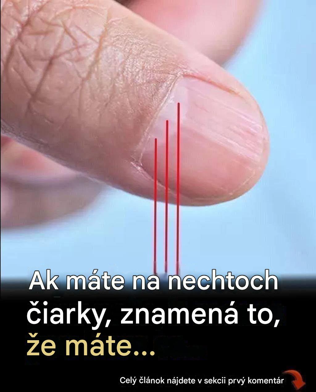 Lekár odhaľuje varovný znak na nechtoch, ktorý môže predpovedať vašu dĺžku života