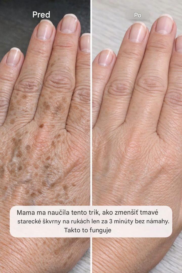 Mama ma naučila tento trik, ako zmenšiť tmavé starecké škvrny na rukách za 3 minúty bez námahy. Funguje to takto.