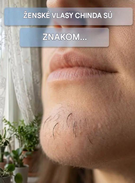 Chĺpky na brade ženy sú znakom… Zobraziť viac