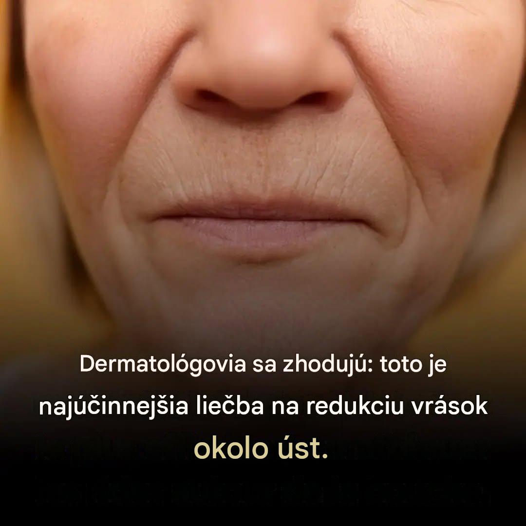Dermatológovia sa zhodujú: toto je najúčinnejšia liečba na redukciu vrások okolo úst.